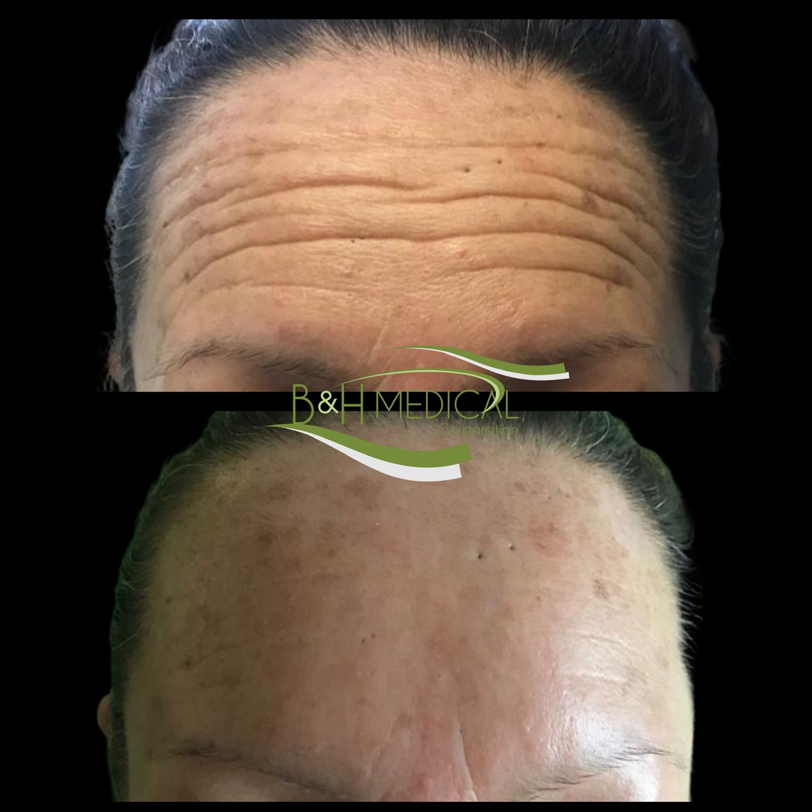 Resultado aplicación de botox 